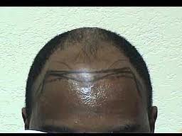 Name:  hairloss_1.JPG
Views: 324
Size:  6.7 KB